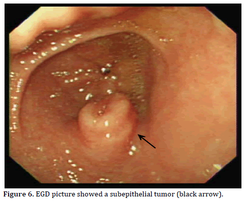 Pancreas-EGD-picture-subepithelial-tumor
