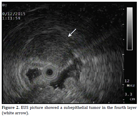 Pancreas-EUS-picture-subepithelial-tumor