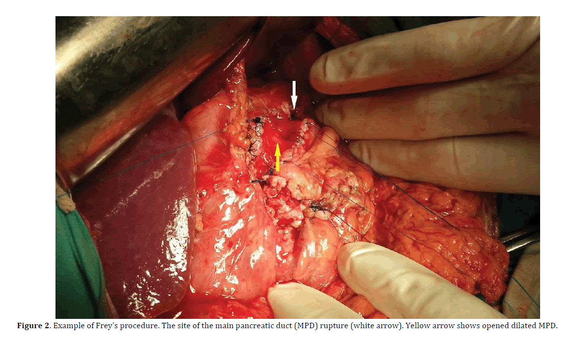 Pancreas-Example-Frey-procedure-pancreatic-duct