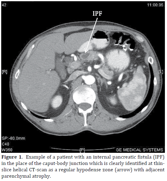 Pancreas-Example-patien-internal-pancreatic