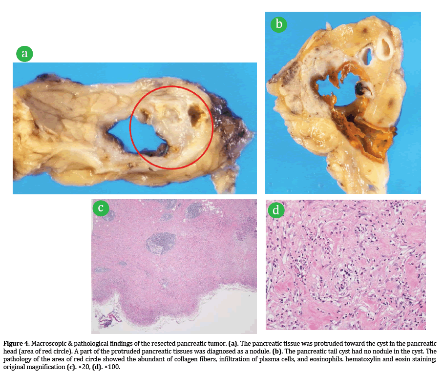 Pancreas-Macroscopic-pathological-findings