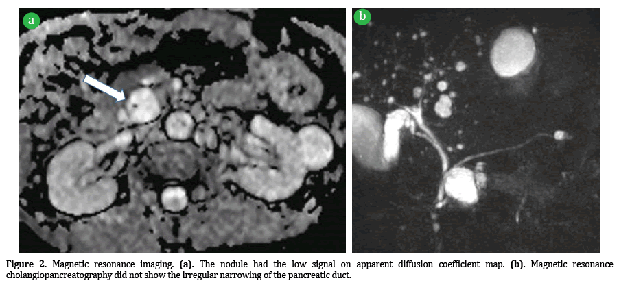 Pancreas-Magnetic-resonance-imaging