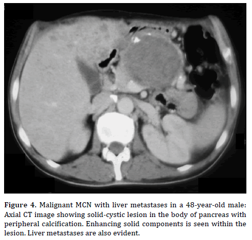 Pancreas-Malignant-MCN-liver-metastases