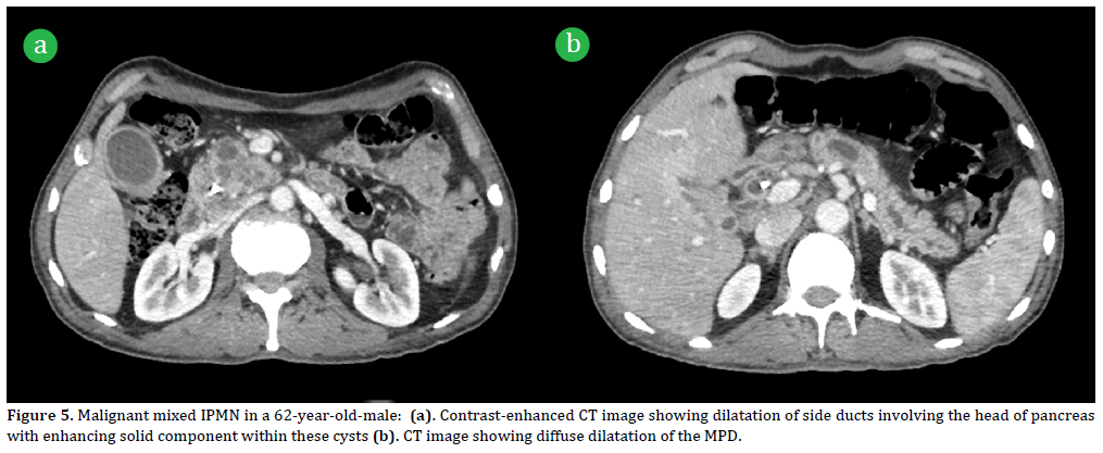 Pancreas-Malignant-mixed-IPMN-62-year-old