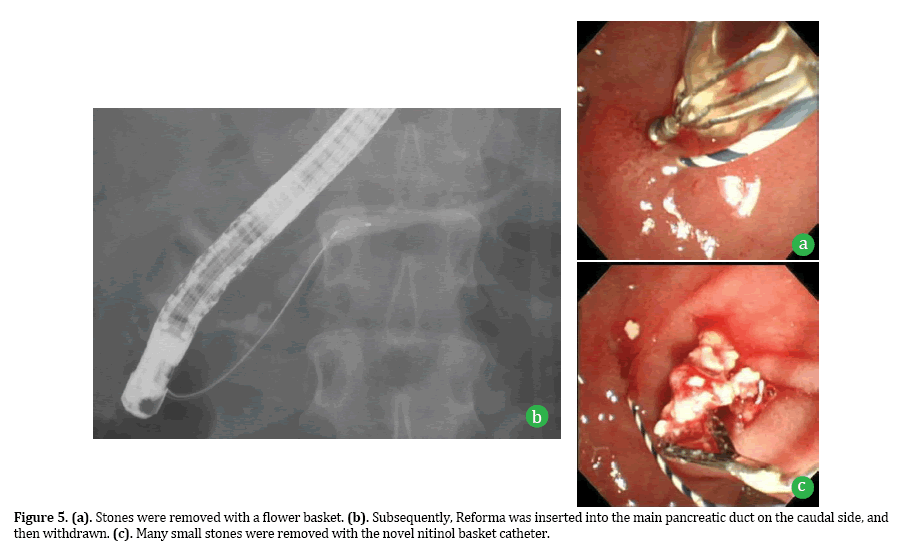 Pancreas-Many-small-stones-removed