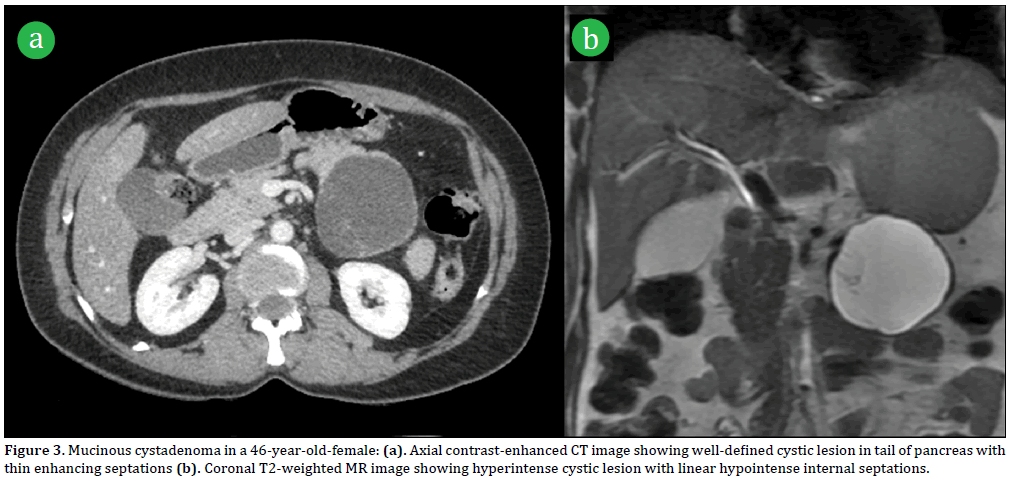 Pancreas-Mucinous-cystadenoma-46-year-old
