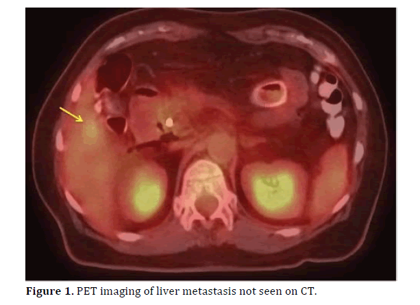 Pancreas-PET-imaging-liver-metastasis