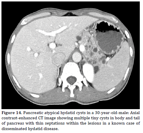 Pancreas-Pancreatic-atypical-hydatid-cysts