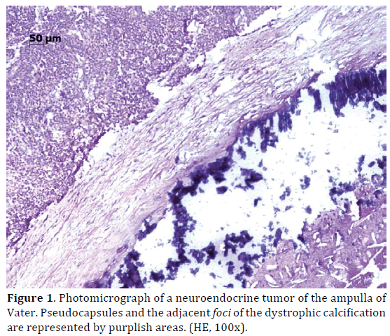 Pancreas-Photomicrograph-neuroendocrine-Pseudocapsules-adjacent