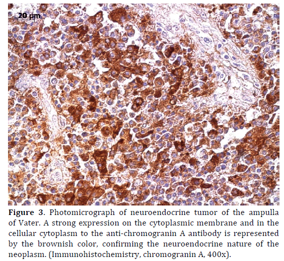 Pancreas-Photomicrograph-neuroendocrine-strong-expression