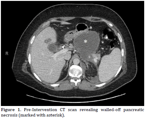 Pancreas-Pre-Intervention-CT-scan