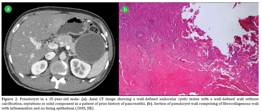 Pancreas-Pseudocyst-35-year-old-male