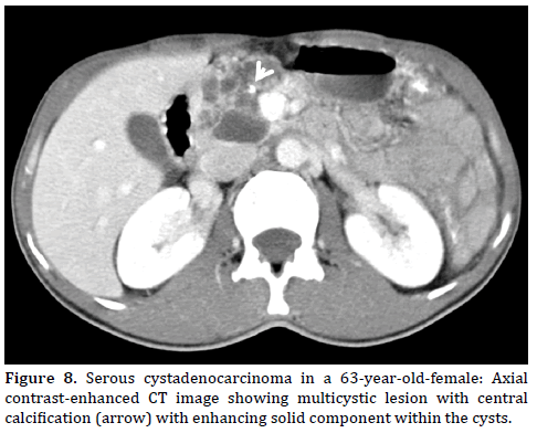 Pancreas-Serous-cystadenocarcinoma-63-year-old