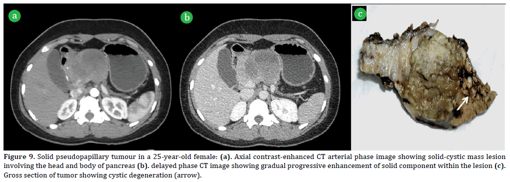 Pancreas-Solid-pseudopapillary-tumour-25-year