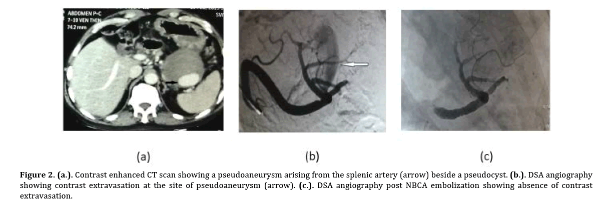 Pancreas-contrast-extravasation