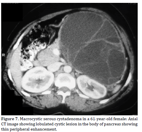 Pancreas-crocystic-serous-cystadenoma-61-year