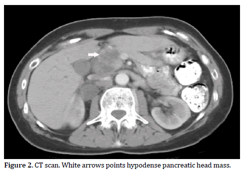 Pancreas-ct-scan-hypodense-head