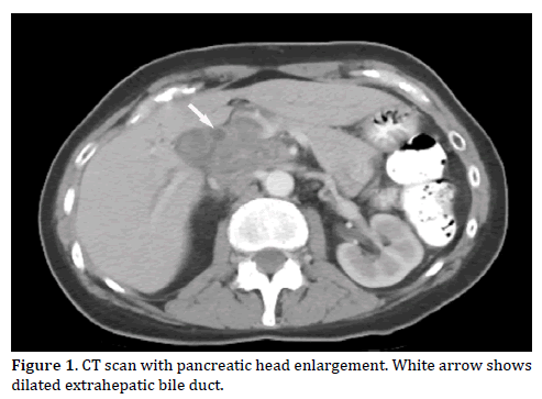 Pancreas-ct-scan-pancreatic-head