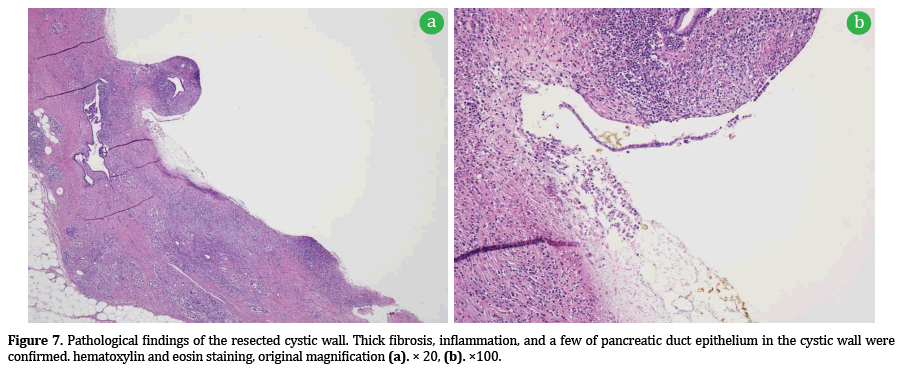 Pancreas-cystic-wall-Thick-fibrosis