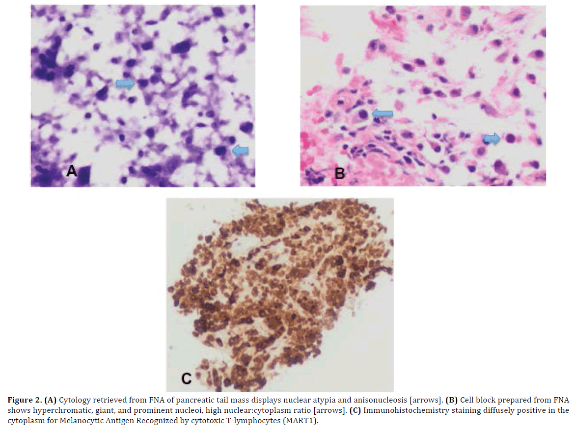 Pancreas-cytology-retrieved-pancreatic