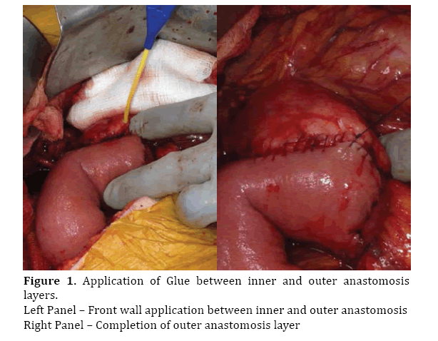 Pancreas-front-wall-application
