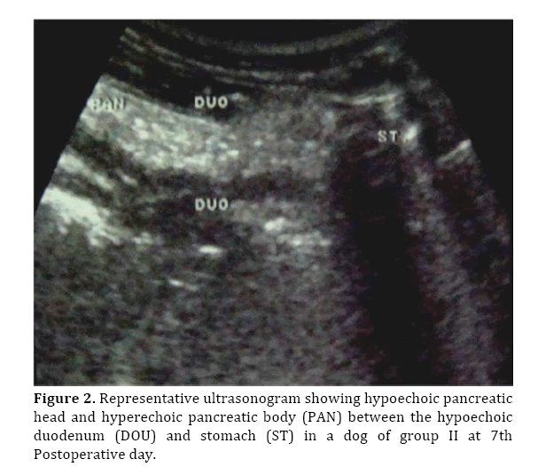 Pancreas-hyperechoic-pancreatic-body