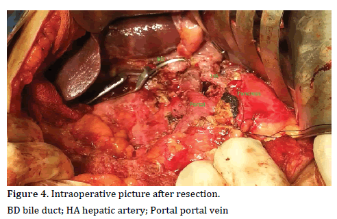 Pancreas-intraoperative-picture
