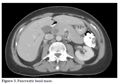 Pancreas-pancreatic-head-mass