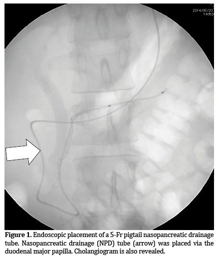 Pancreas-pigtail-nasopancreatic-drainage