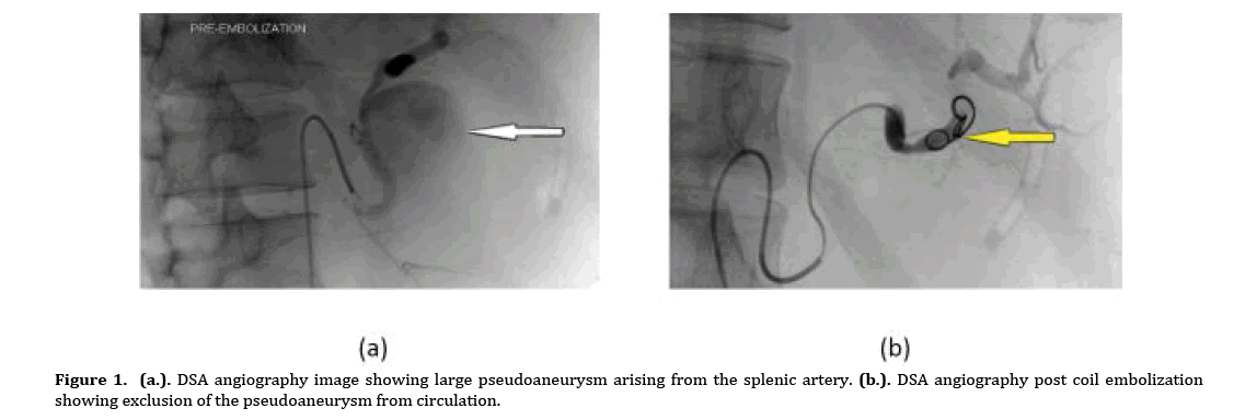 Pancreas-pseudoaneurysm-arising