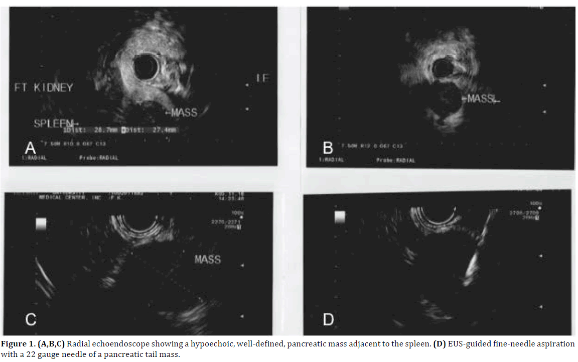 Pancreas-radial-echoendoscope-hypoechoic