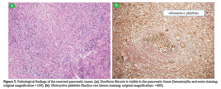 Pancreas-resected-pancreatic-tumor