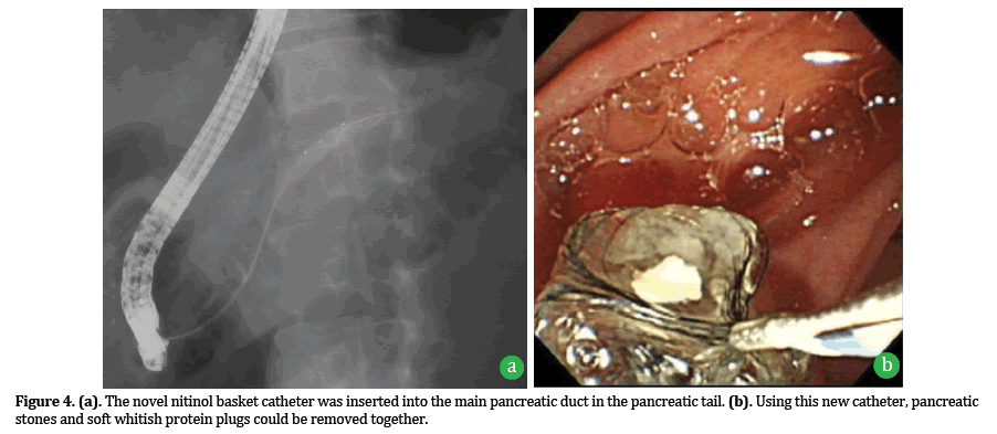 Pancreas-soft-whitish-protein-plugs