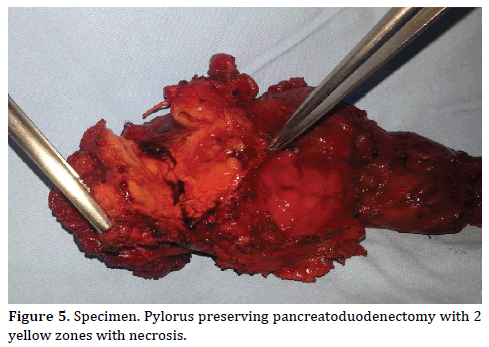 Pancreas-specimen-Pylorus-zones