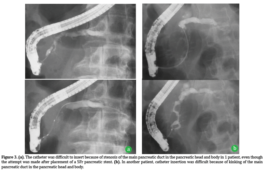 Pancreas-stenosis-main-pancreatic-duct