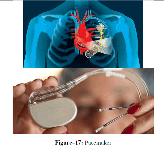 advanced-drug-delivery-pacemaker