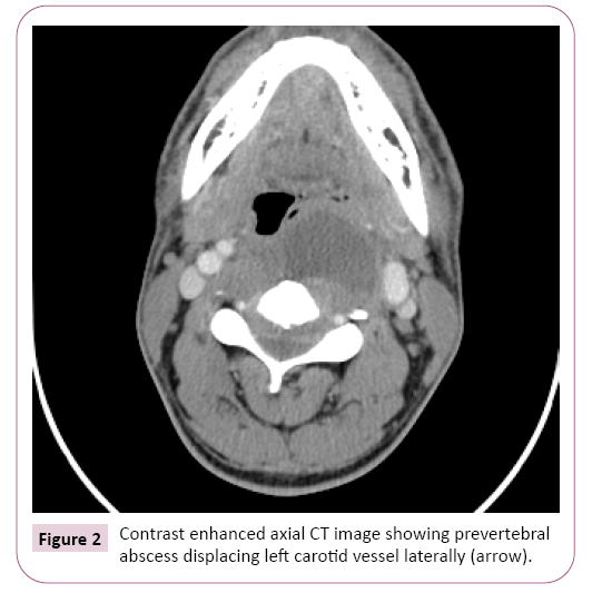 Primary Tuberculous Retropharyngeal Abscess