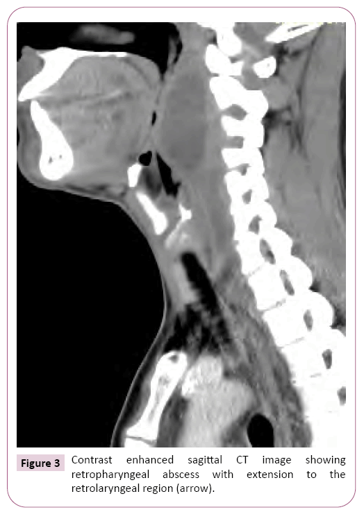 advances-in-applied-science-research-retropharyngeal