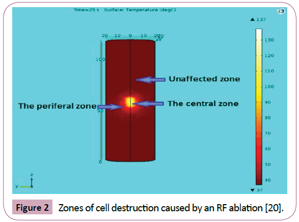applied-science-research-review-RF-ablation