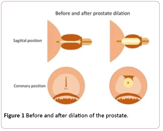 biochem-molbio-dilation-prostate