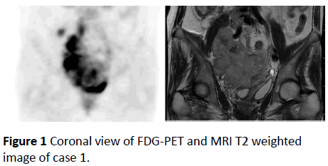 biomarkers-Coronal-view-FDG-PET