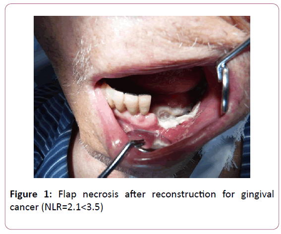 biomarkers-Flap-necrosis