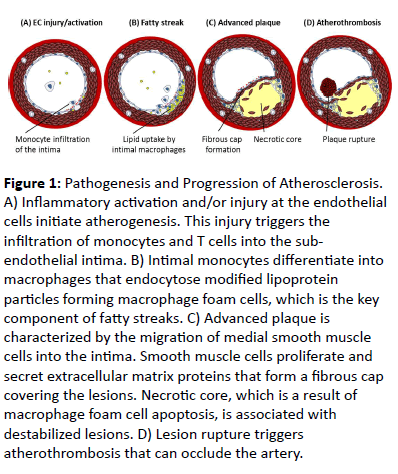 biomarkers-Pathogenesis-Progression-Atherosclerosis
