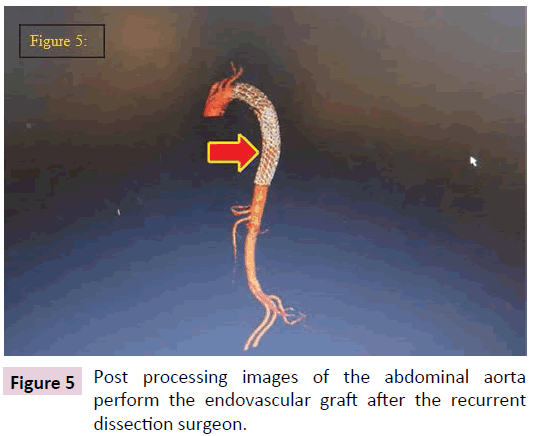 biomarkers-abdominal-aorta