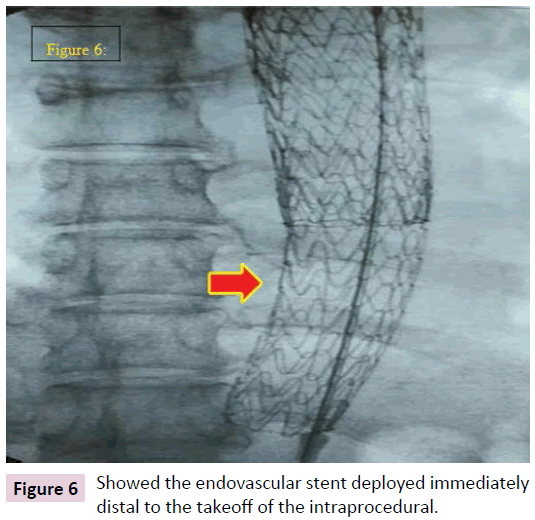 biomarkers-endovascular-stent-deployed