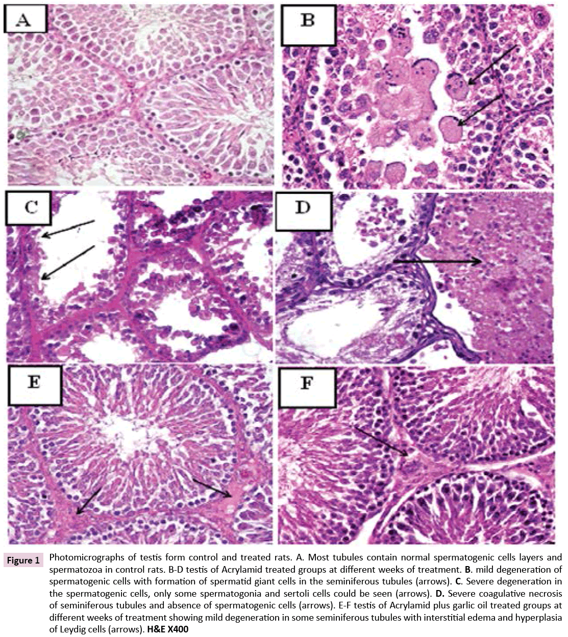 biomarkers-interstitial-edema-hyperplasia