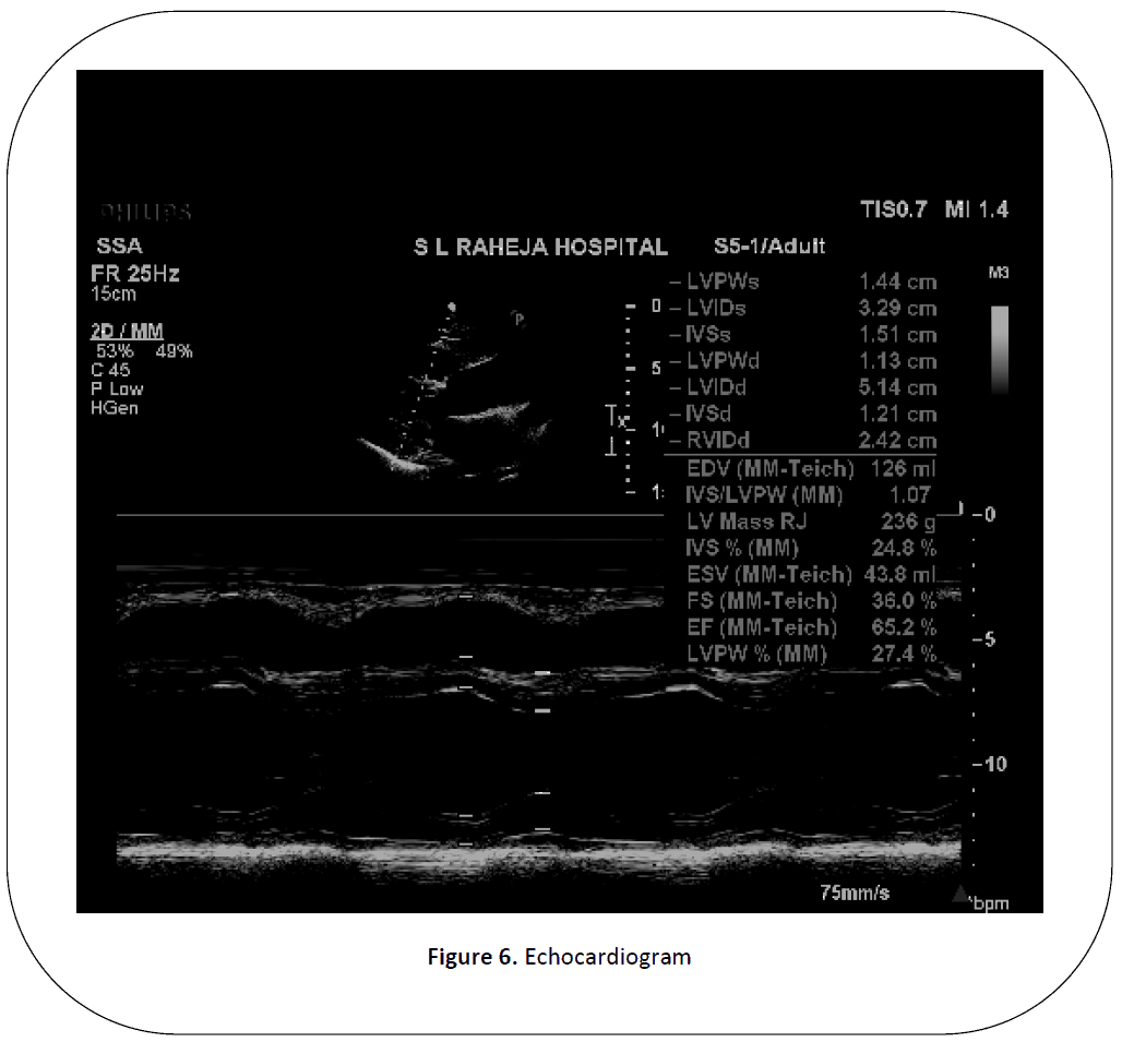 british-journal-Echocardiogram