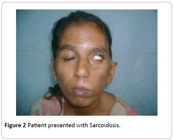 british-journal-of-research-Patient-presented-Sarcoidosis