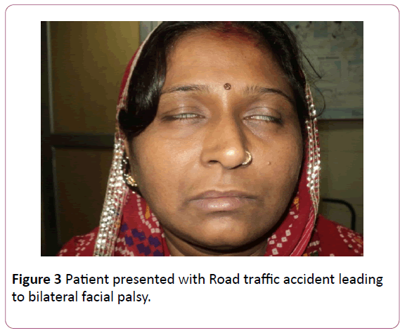 british-journal-of-research-bilateral-facial-palsy