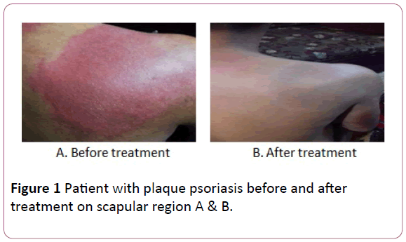 british-journal-of-research-plaque-psoriasis
